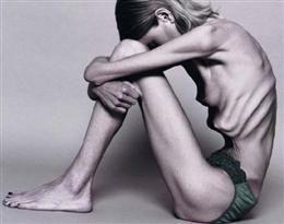 Francia: nuevas medidas contra la anorexia